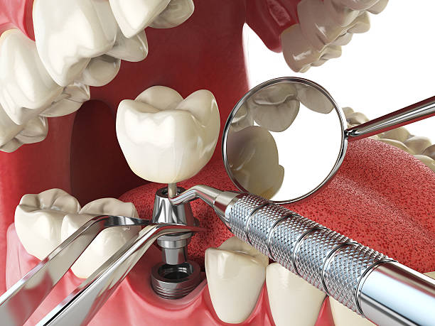 Best Emergency Tooth Extraction in Riverview, DE